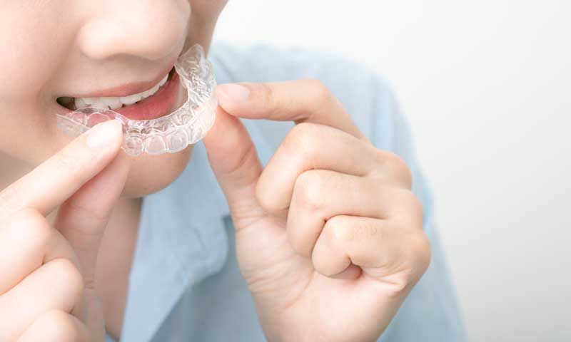 Braces and Clear Aligners in Windsor, ON