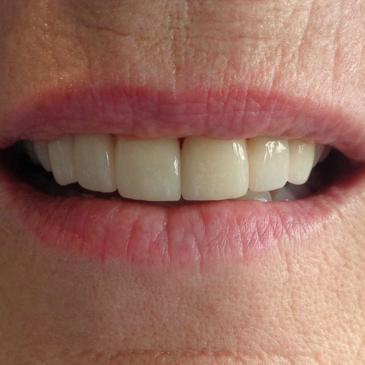 After dental veneers by Your Windsor Dental Care
