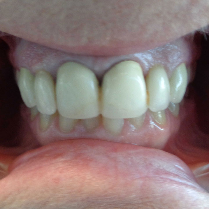 Teeth whitening before by Your Windsor Dental Care