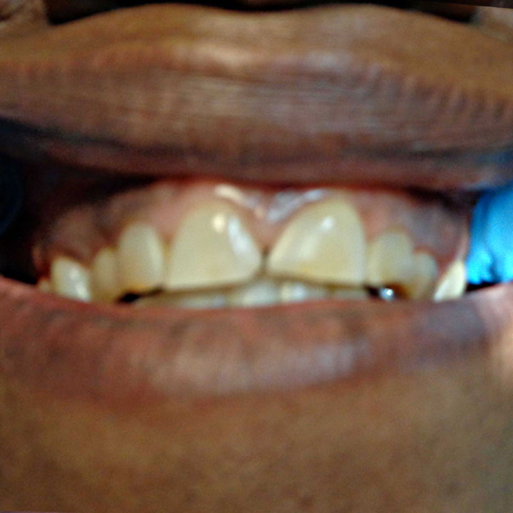 Before cosmetic dentistry by Your Windsor Dental Care