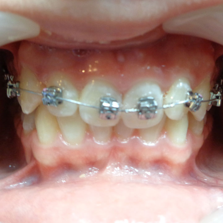 Before braces by Your Windsor Dental Care