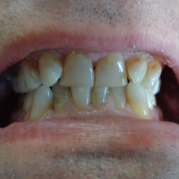Before dental implants by Your Windsor Dental Care
